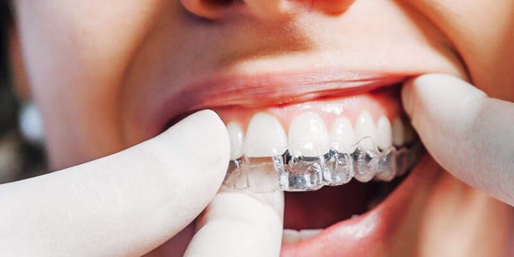 Clear Aligners